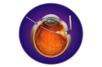 Illustration of a VEKTOR Laser probe going through an eyeball.