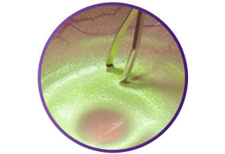 Close up of the SHARKSKIN ILM forceps touching ILM tissue.